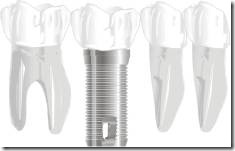 Molar dental implants replacement