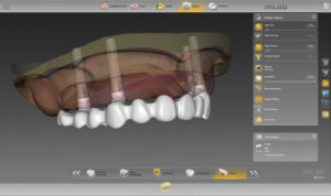 Cerec Inlab in Israel