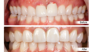 bruxzir zirconia-before after